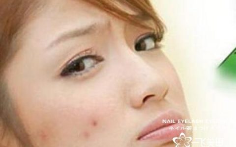 護(hù)膚小常識(shí) 將你如何快速祛痘