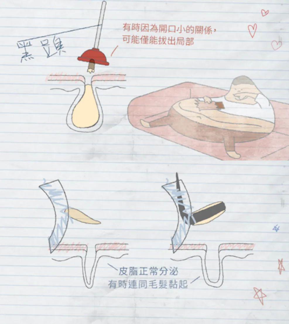 去黑頭最全攻略！一篇告訴你黑頭怎么去除最有效！