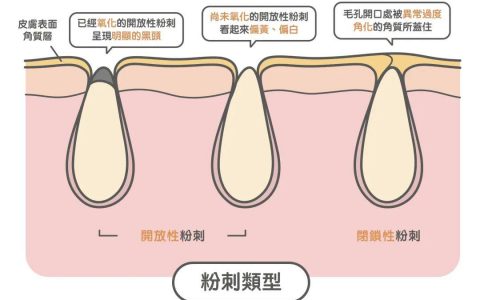 去黑頭最全攻略！一篇告訴你黑頭怎么去除最有效！