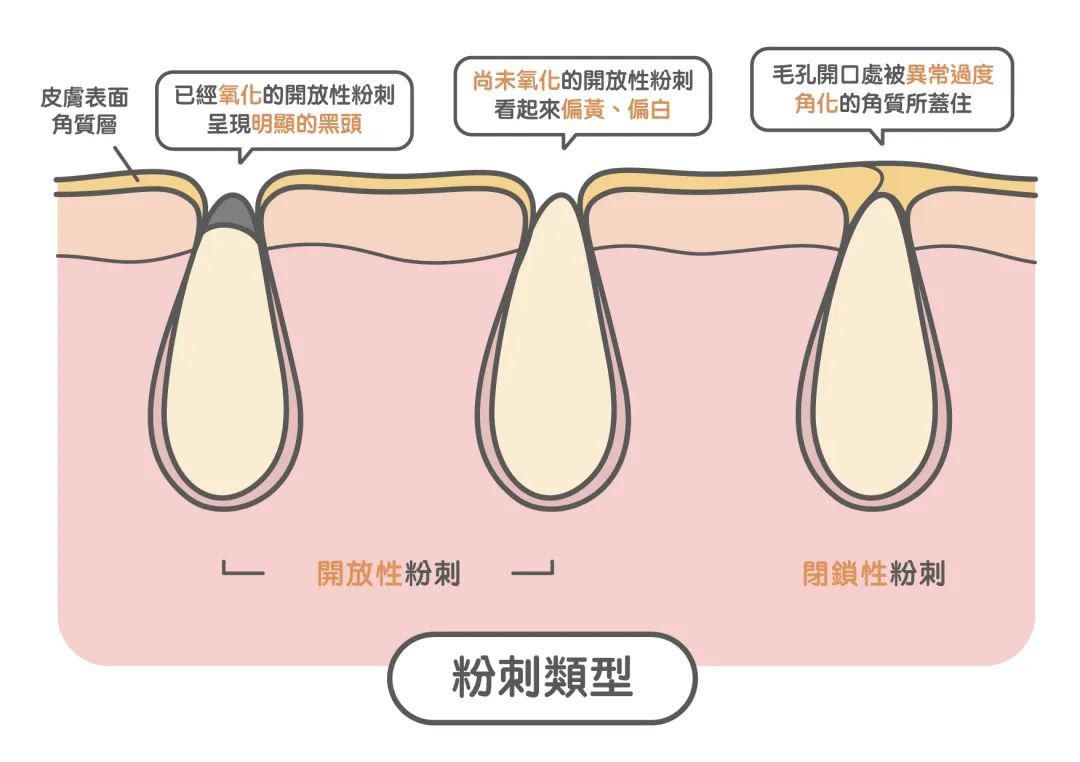 去黑頭最全攻略！一篇告訴你黑頭怎么去除最有效！