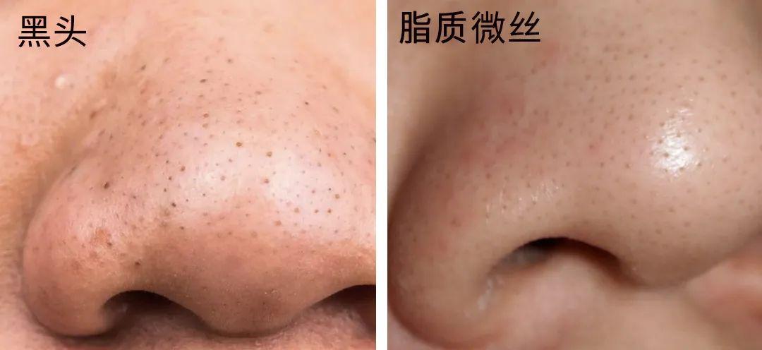 去黑頭最全攻略！一篇告訴你黑頭怎么去除最有效！