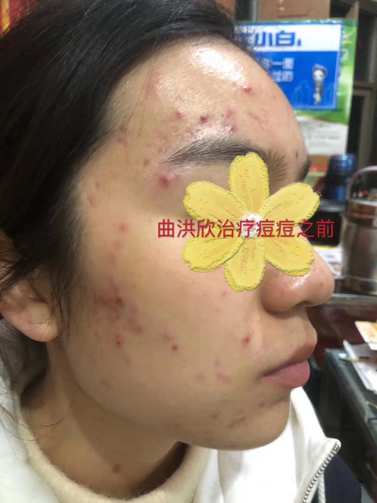 痘痘的病因有哪些？為什么會長痘？