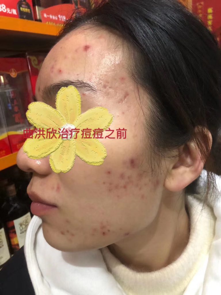 痘痘的病因有哪些？為什么會長痘？