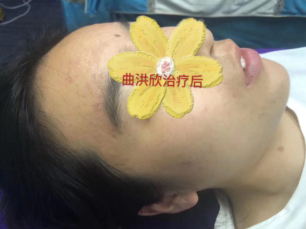痘痘的病因有哪些？為什么會長痘？