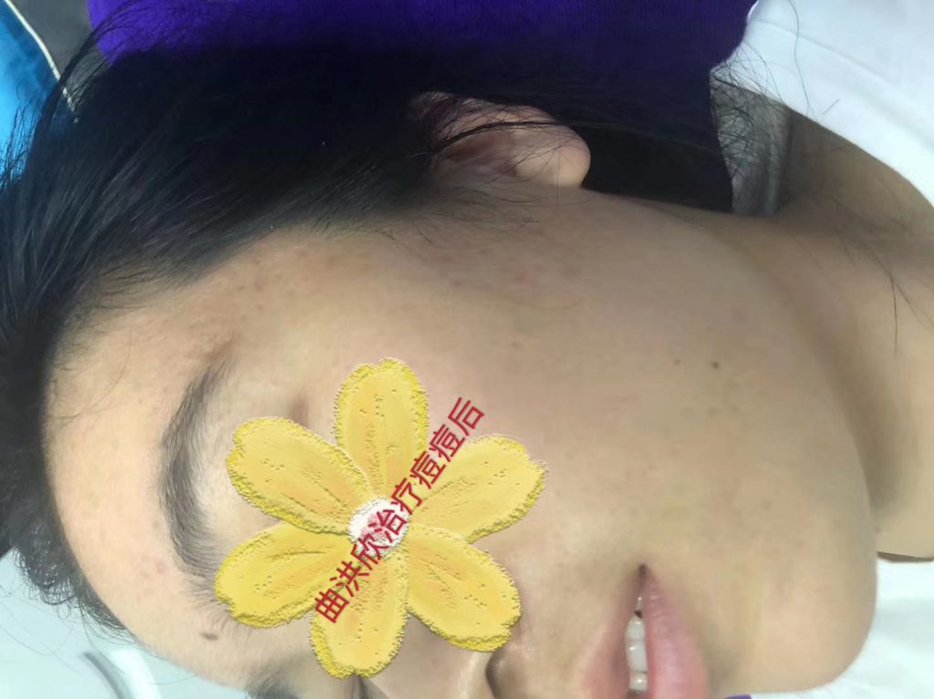 痘痘的病因有哪些？為什么會長痘？