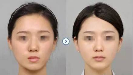 自體脂肪填充，你不知道的都在這里！