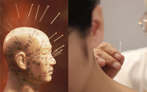 針灸減肥位置圖，，有哪些正確的步驟