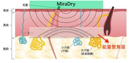 miraDry清新微波：腋臭基因到底有多強大，看看這些內(nèi)容就知道