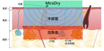miraDry清新微波：腋臭基因到底有多強大，看看這些內(nèi)容就知道