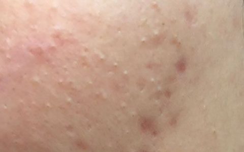 點斑掉痂后能擦粉底嗎