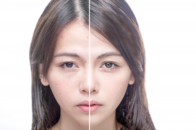 有痘的皮膚怎么護(hù)理，教你怎么正確護(hù)理油痘肌