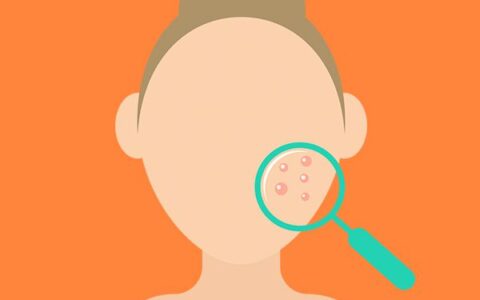 熬夜長痘痘如何消除 正確護(hù)膚方法還你嫩白無瑕肌