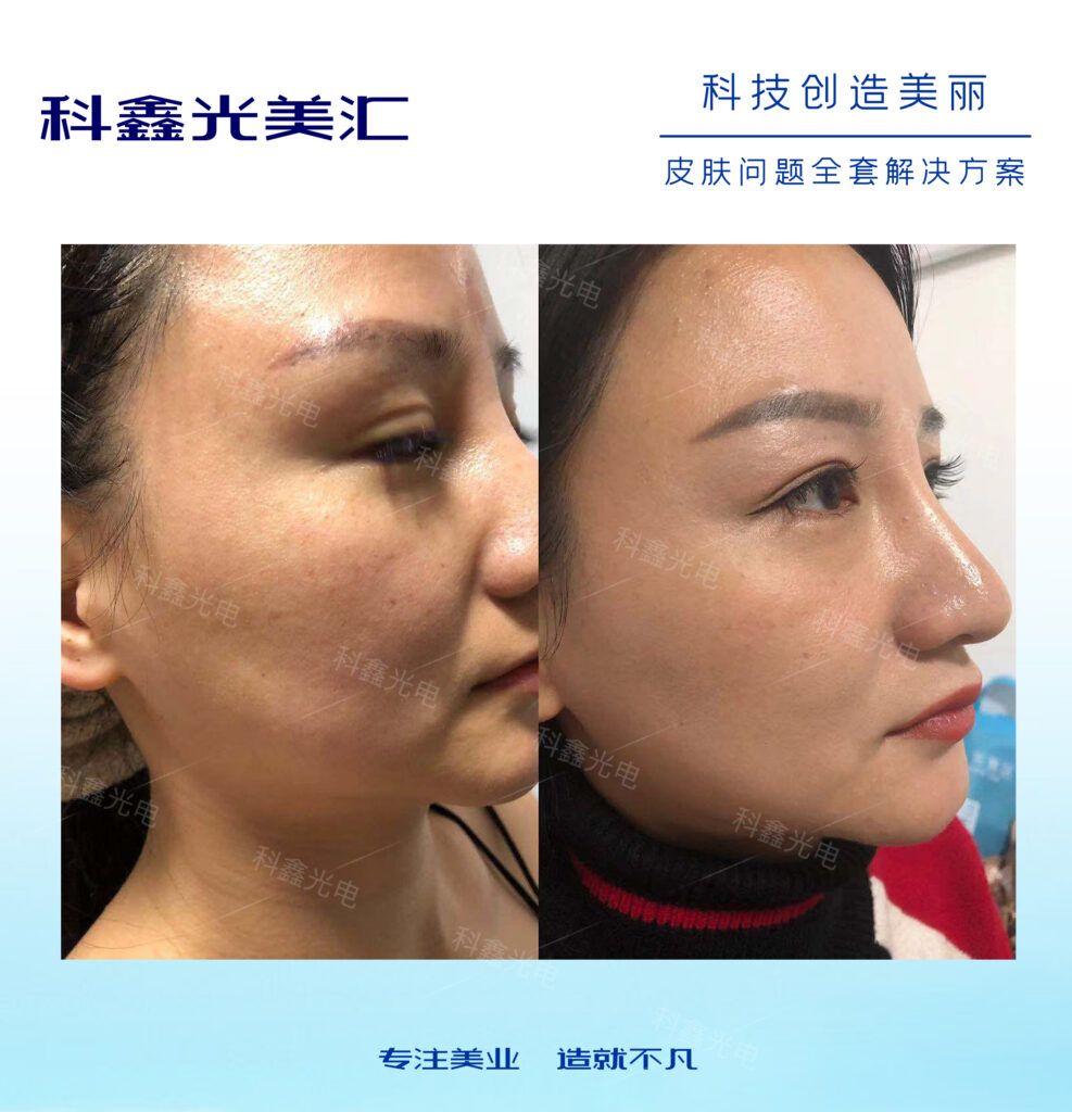 做完點陣激光術后怎么修復和護理？