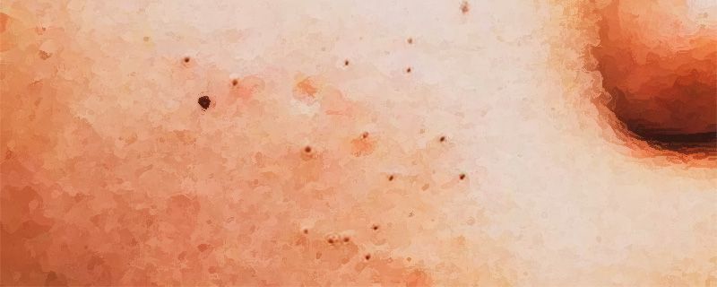 閉口粉刺不美觀，怎么才能避免